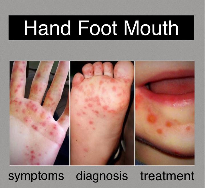 “देहरादून में हैंड-फुट-माउथ डिजीज का प्रकोप, स्कूलों ने एहतियात बरतने को लेकर जारी किया अलर्ट”